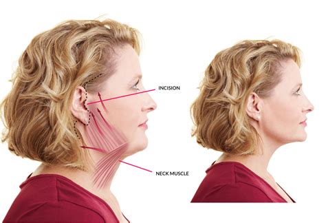 Mini Neck Lift: What It Does, How Much It Costs, .